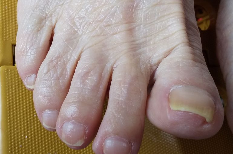 爪伸びすぎ・ケア後