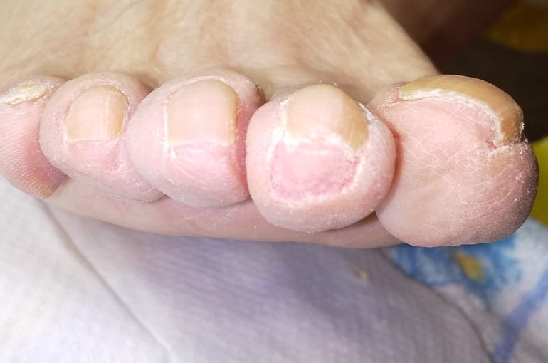 爪伸びすぎ処置後