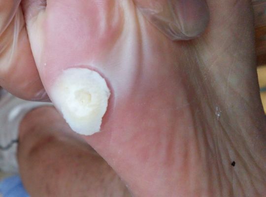 鶏眼にスピール膏