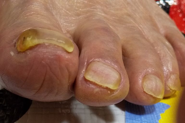 爪切りケア卒業時