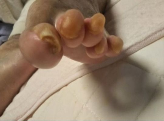 これも巻き爪