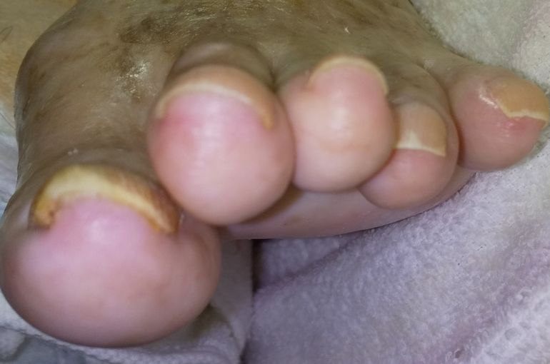 巻き爪解消