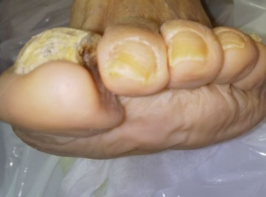 変形した爪
