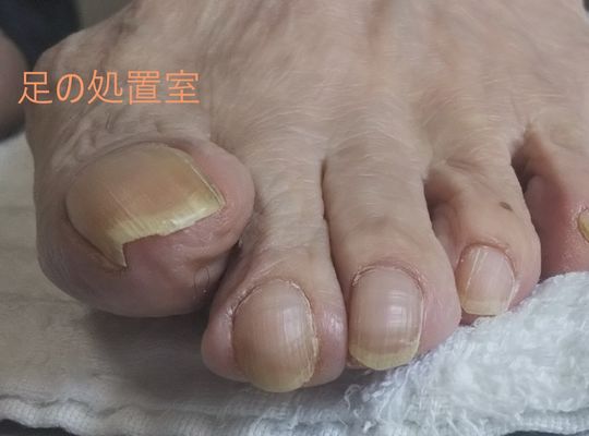 いろいろな巻き爪