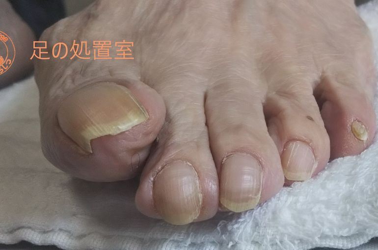 いろいろな巻き爪