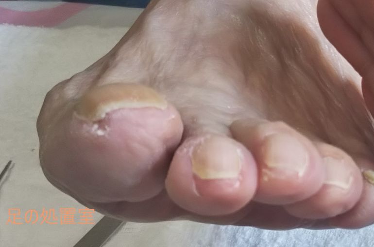 いろいろな巻き爪2