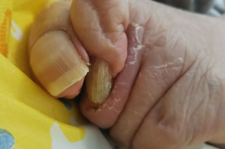 ゆびの変形・爪の変形