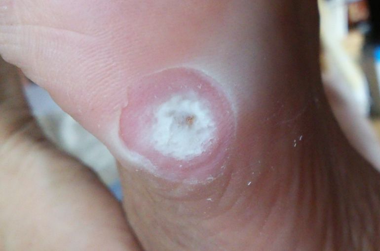 スピール膏の弊害
