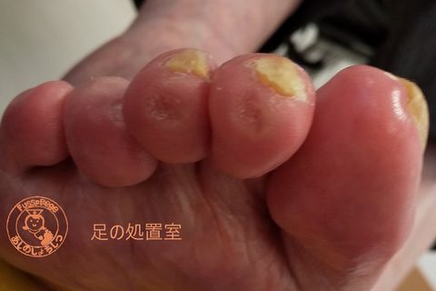 魚の目処置後