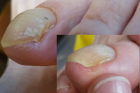 巻き爪気味。カットで改善。